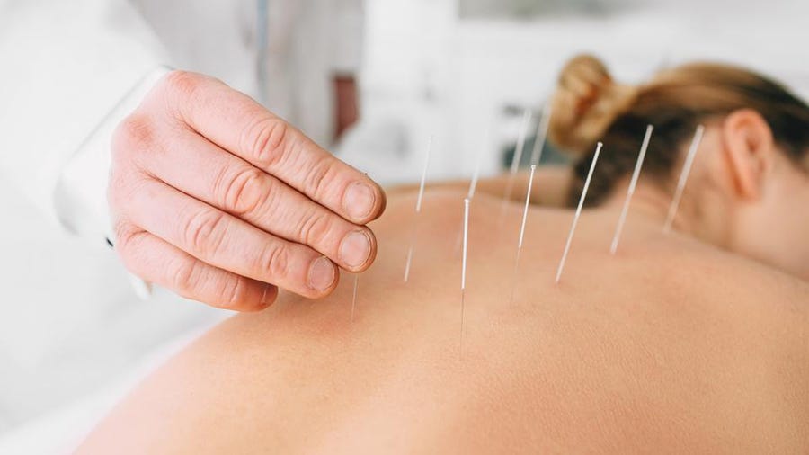 acupuncture